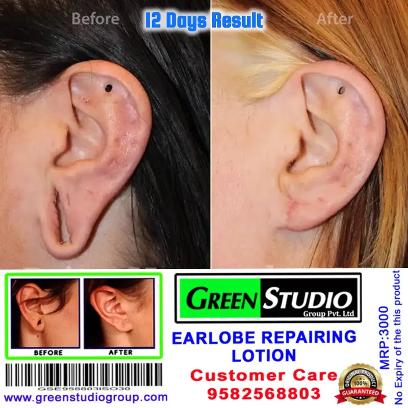 Buy Earlobe Repair Lotion Earhole Pasting Solution Close Big